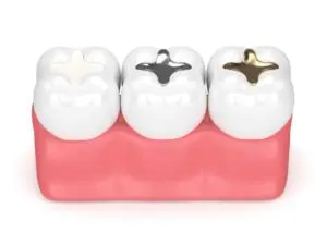The three types of dental fillings shown composite resins, amalgam and gold