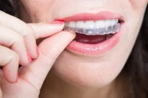 Invisalign teeth straightening available at Harvest Dental