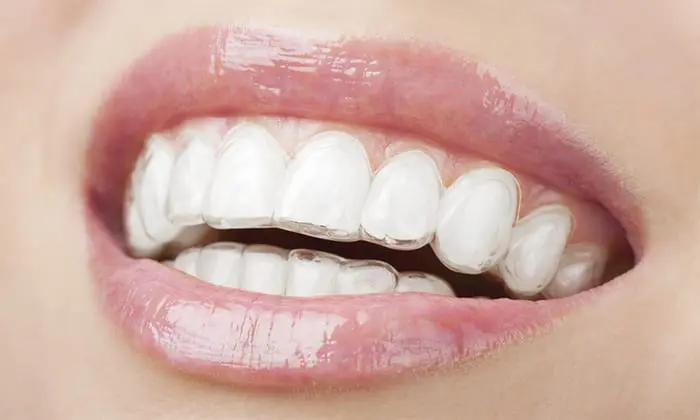 Close up image of woman wearing Invisalign orthodontic mouth guard